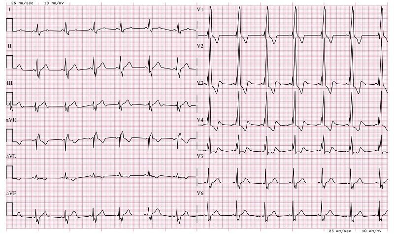 右脚ブロック（RBBB）の12誘導心電図_ECG RBBB (Right Bundle Branch Block) - 12 Lead ECG Common Case - 6 Sec/lead