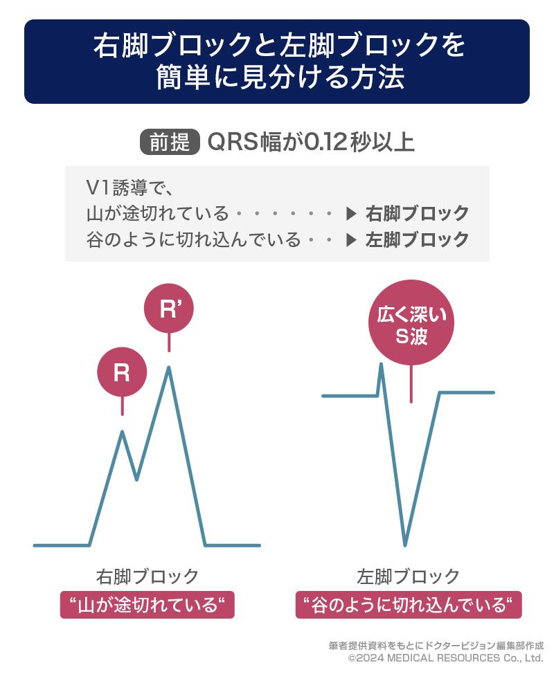 右脚ブロックと左脚ブロックを簡単に見分ける方法_ドクタービジョン