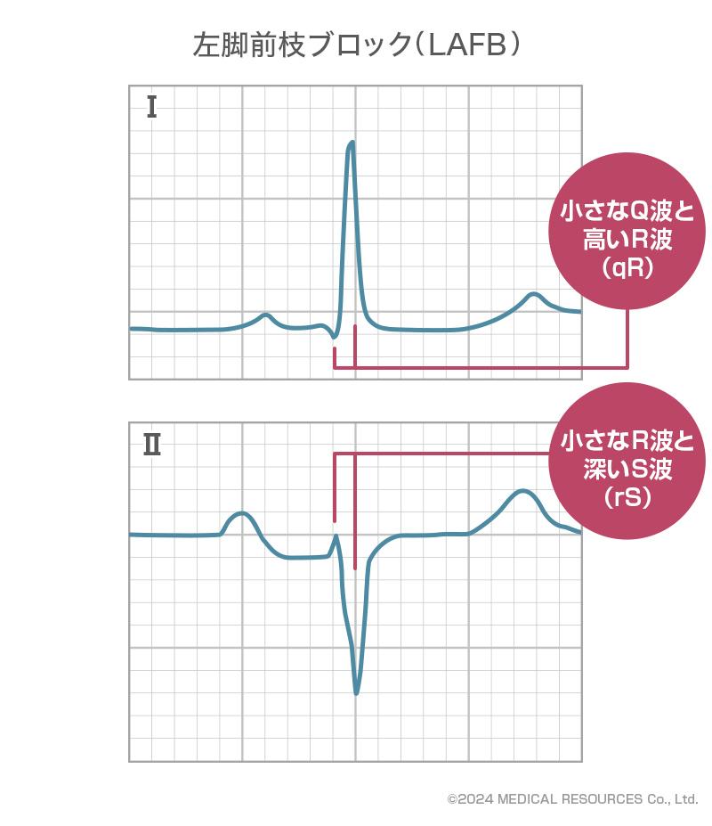 左脚前枝ブロック（LAFB）の心電図所見の特徴_ドクタービジョン