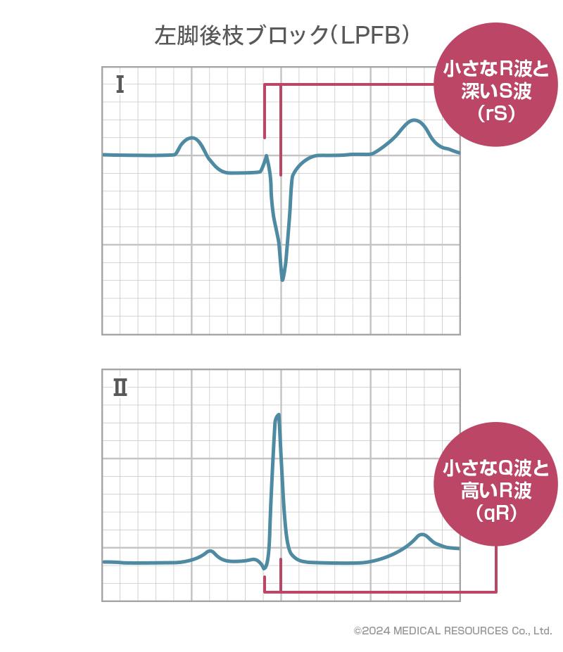 左脚後枝ブロック（LPFB）の心電図所見の特徴_ドクタービジョン