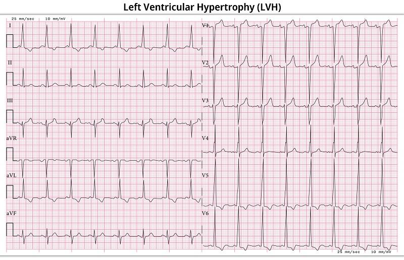 左室肥大の12誘導心電図_ECG Left Ventricular Hypertrophy (LVH) - Left Ventricular Enlargement - 12 Lead ECG Common Case - 6 Sec/lead