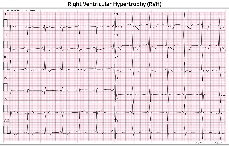 右室肥大の12誘導心電図_ECG Right Ventricular Hypertrophy (RVH) - Right Ventricular Enlargement - 12 Lead ECG Common Case - 6 Sec/lead