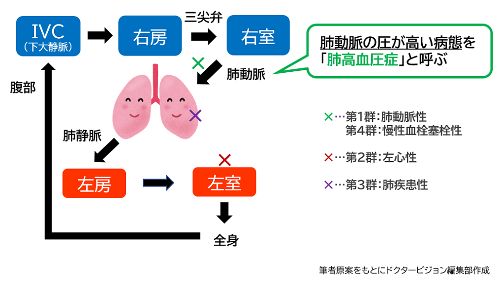 肺高血圧症の病態の概略_ドクタービジョン