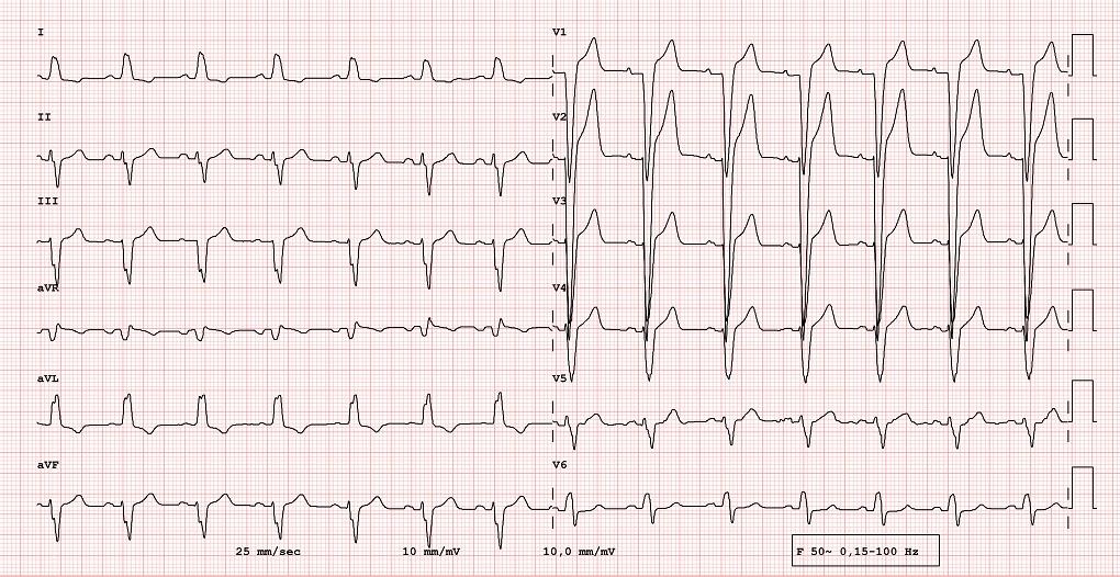 左脚ブロック（LBBB）の12誘導心電図_ECG example of 12-lead rhythm, left bundle branch block, real exam