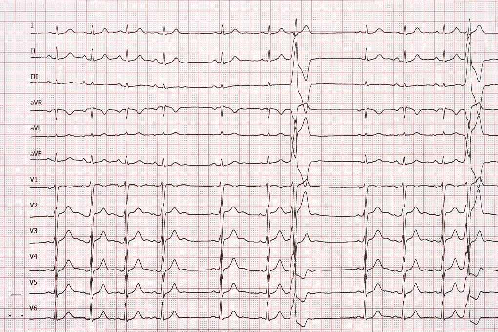 期外収縮の12誘導心電図_Extrasystole On 12 Lead Electrocardiogram Record Paper