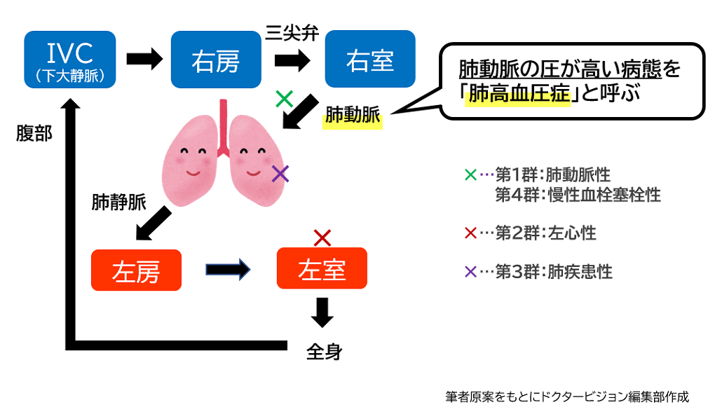 肺高血圧症の病態の概略_ドクタービジョン