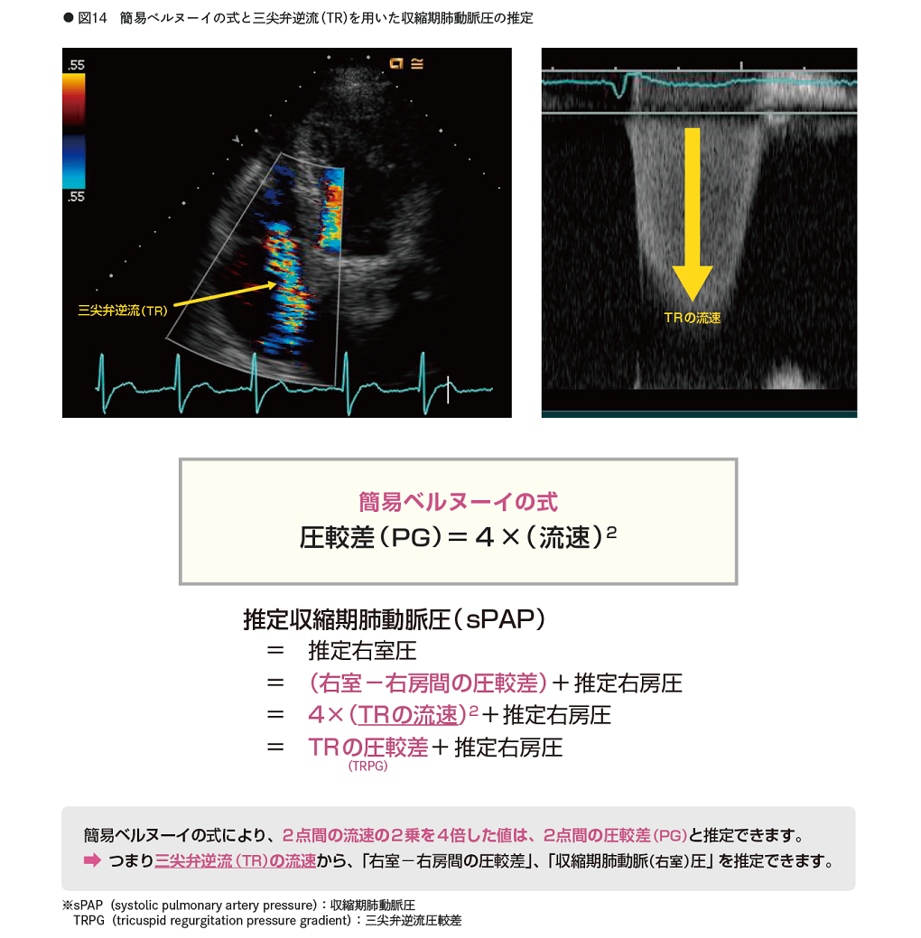 ドクタービジョン資料_心エコー図ファーストマニュアル_p24_簡易ベルヌーイの式と三尖弁逆流を用いた収縮期肺動脈圧の推定